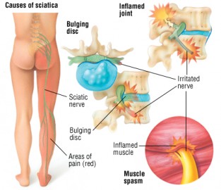 Description of sciatica found on www.drugs.com