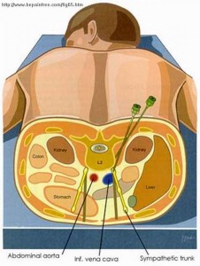 This is a great depiction of the procedure! This is from a site depiction of the Lumbar Sympathetic Block done by Pitt.Edu