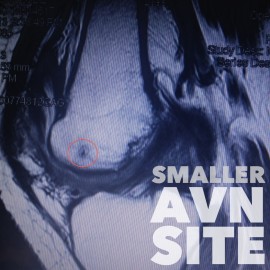 This is the last MRI I had which showed the small AVN site on the medial side of my knee.