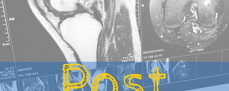 Post Regenexx Update 6 and 7 months Out - Avascular Necrosis Stem Cell Femur (Knee) Procedure